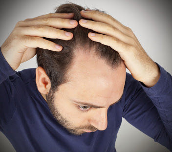 Male Pattern Baldness: Causes, Stages and Possible Treatments